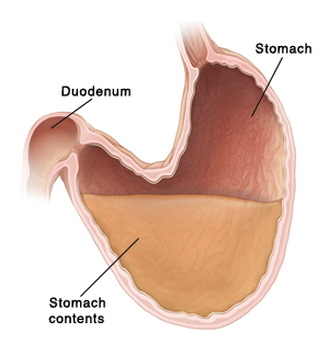 Cross section of stomach and duodenum. Stomach is large and sagging. Stomach contents in sagging part cannot move properly out of stomach to duodenum.