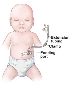 Outline of baby with tube inserted in stomach. Feeding port is near skin, and clamp is on extension tubing.