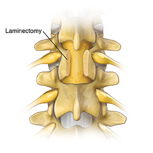Back view of lumbar spine showing part of one vertebra removed.