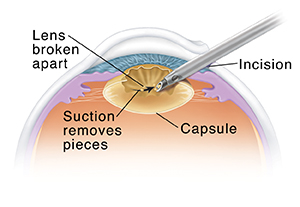 Krames Online - Small-Incision Cataract Surgery: Removing The Old Lens