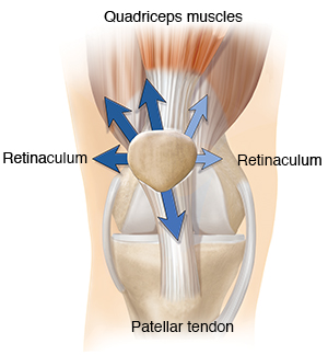 Front view of normal knee joint with arrows showing forces pulling unevenly on patella.