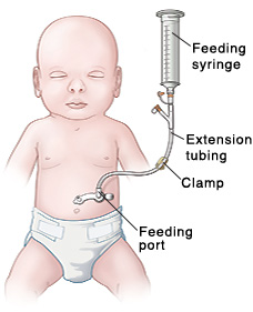 Outline of baby with tube inserted in stomach. Feeding port is near skin, and clamp is on extension tubing. Feeding syringe is inserted into extension tubing.