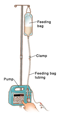 Feeding bag hanging from pole on pump. Feeding bag tubing goes from bag to pump. Clamp is in middle of tubing. Finger is pressing the On button.