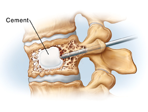 Side view of compressed vertebra and disks. Needle goes through back of vertebra into vertebral body and injects cement in open space left by balloon.