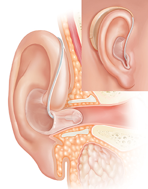 Cross section of ear showing outer, inner, and middle ear structures with behind-the-ear hearing aid in place with inset of external view.