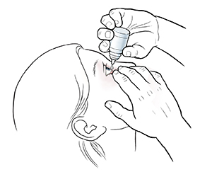 Woman leaning head back and pulling gently down on lower eyelid. Other hand is holding eyedrops bottle over eye.