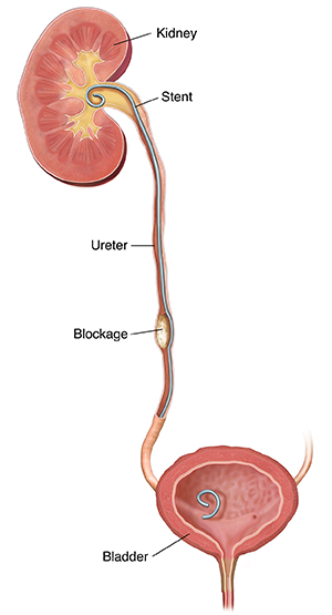 Cross section of kidney, ureter, and bladder with stent in place.