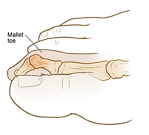 Side view of foot showing mallet toe.