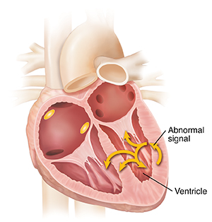 Cross section of heart showing ventricular tachycardia.