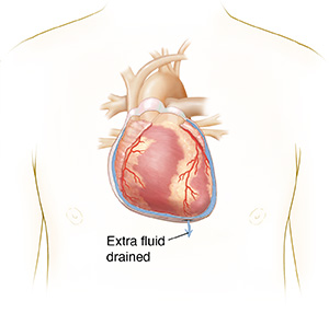 Front view of person's chest showing extra fluid drained from the pericardium.