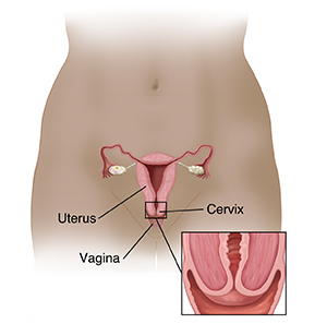 Front view of woman's pelvis showing cross section of uterus, ovaries, cervix, vagina, and fallopian tubes. Inset shows closeup cross section of cervix.