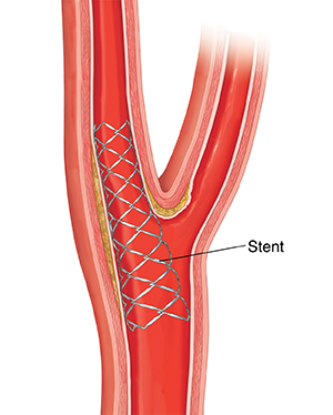 Corte transversal de la arteria carótida que muestra un stent colocado.
