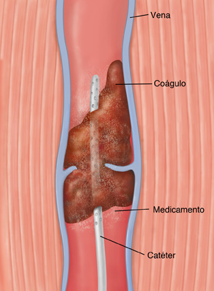 Corte transversal de una vena con un coágulo sanguíneo donde se ve un catéter que libera medicamento en el coágulo.