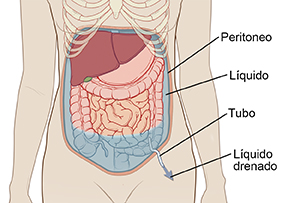 Contorno del abdomen de una mujer donde se observa una sonda insertada a través de la piel hasta el abdomen para drenar el líquido.