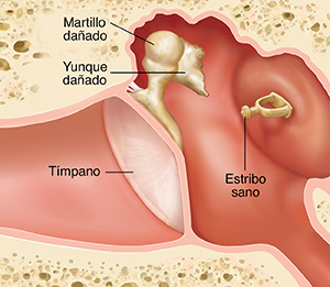 Corte transversal de un oído donde pueden verse las estructuras del oído externo, interno y medio, con el yunque dañado.
