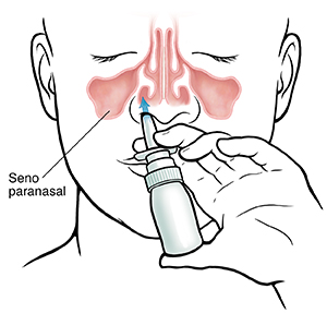 Vista frontal de una cara en la que pueden verse los senos paranasales y la técnica correcta para usar el espray nasal.