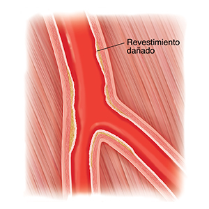 Corte transversal de una arteria periférica con revestimiento dañado.