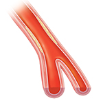 Corte transversal de una arteria donde se ven la placa comprimida y la sangre fluyendo libremente.