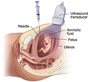 Vista lateral de una embarazada en la que se ve el feto, la sonda de ecografía y una aguja que toma una muestra del líquido amniótico para la amniocentesis.