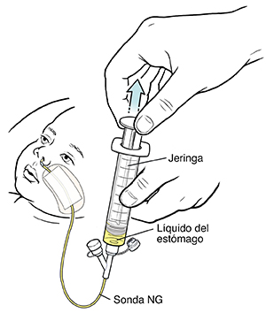 Mano jalando del émbolo de la jeringa que está conectada a una sonda nasogástrica de un niño pequeño. El líquido comienza a llenar la jeringa.