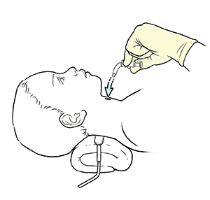 Niño acostado boca arriba con una almohada debajo del cuello. Una mano enguantada inserta un tubo de traqueostomía nuevo en el cuello del niño.