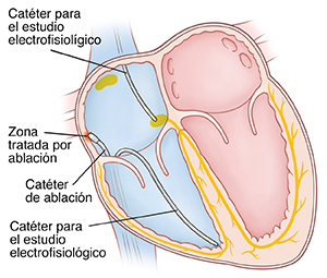 Corte transversal de un corazón en el que pueden verse los catéteres insertados en la aurícula y el ventrículo derechos para el procedimiento de ablación.