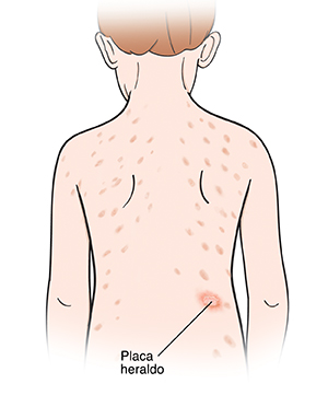 Contorno de un niño visto de atrás que muestra un sarpullido en la espalda. La mancha grande de sarpullido es la placa heráldica.