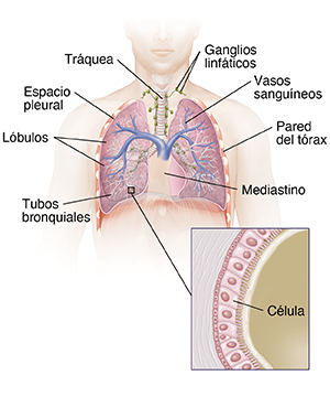 Vista frontal del tórax de un hombre donde pueden verse la tráquea y los pulmones. El recuadro muestra las células del bronquiolo.