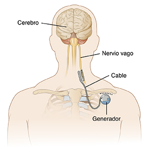 Vista frontal de la cabeza y el pecho de un hombre donde se observa el dispositivo de estimulación del nervio vago implantado cerca de la clavícula.