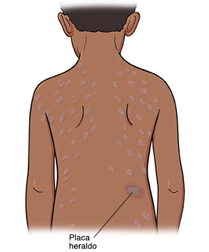 Contorno de un niño visto de atrás que muestra salpullido en la espalda. Una mancha grande de salpullido es la placa heráldica.