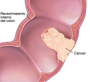 Corte transversal del colon que muestra el cáncer.