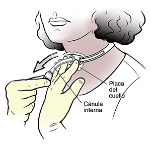 Mujer quitando una cánula de traqueostomía del cuello.
