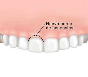 Una línea punteada muestra la nueva línea de la encía.