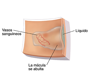 Primer plano de la retina con degeneración macular húmeda donde se observan vasos sanguíneos y líquido.