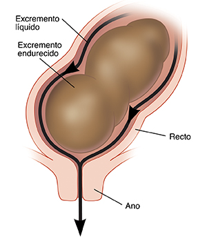 Primer plano de corte transversal del recto y del ano donde puede verse líquido que sale alrededor de heces endurecidas.