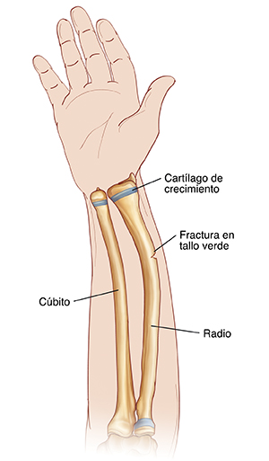 Vista de la palma de la mano y antebrazo donde pueden verse el radio y el cúbito. Una fractura en tallo verde atraviesa parcialmente el radio. Las placas de crecimiento se encuentran cerca de la muñeca.